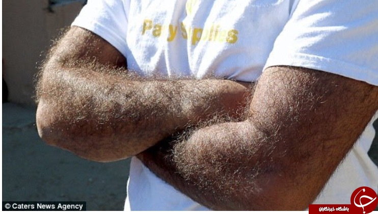 «مرد گرگی» که ۹۸ درصد بدنش را مو پوشانده است+ تصاویر