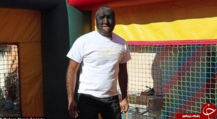 «مرد گرگی» که ۹۸ درصد بدنش را مو پوشانده است+ تصاویر